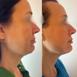 Hifu before and after images