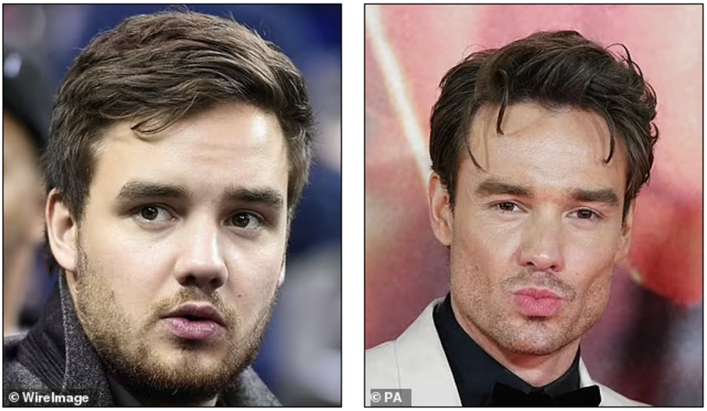 Liam Payne Ozempic face Before and After photos